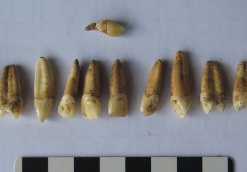 Supernumerary tooth