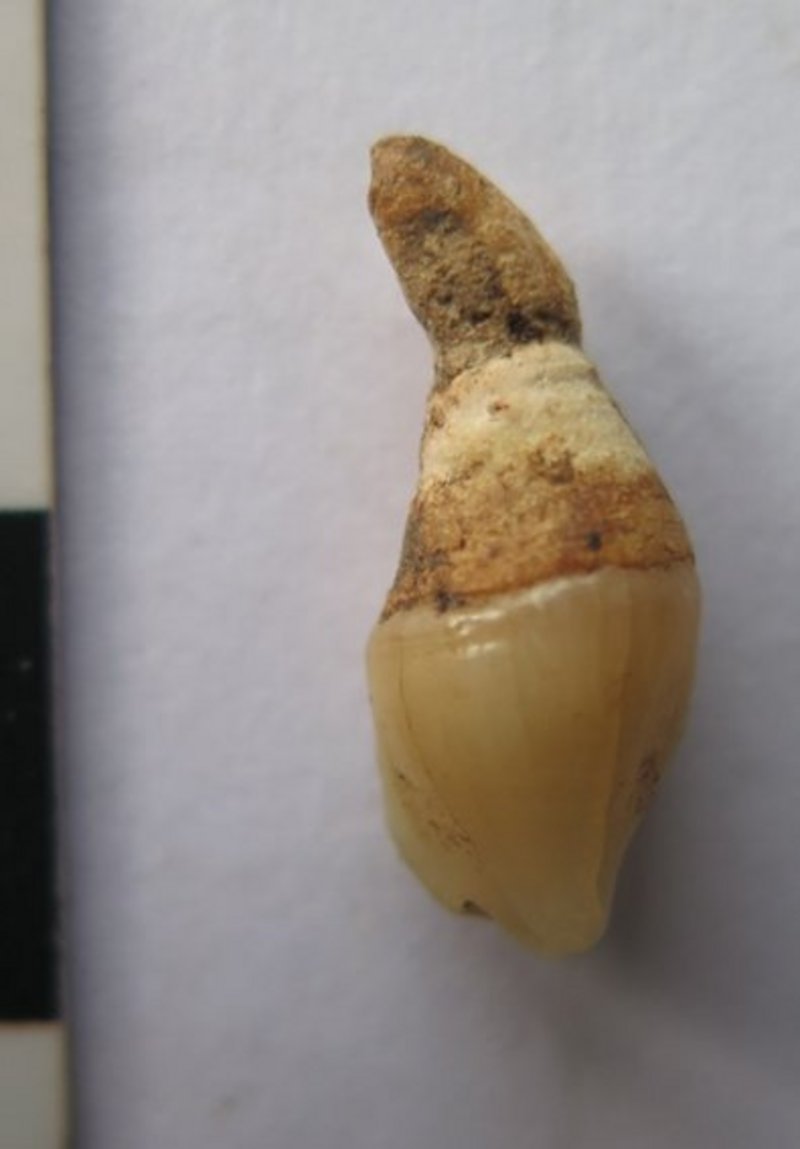 Maxillary teeth with supernumerary tooth